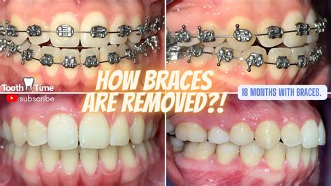 how to remove metal brackets from teeth|how to remove braces after cleaning.